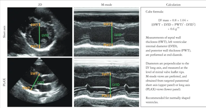 Fig. 2. Calculation of LV mass with an echocardiographic linear method. LV: left ventricle