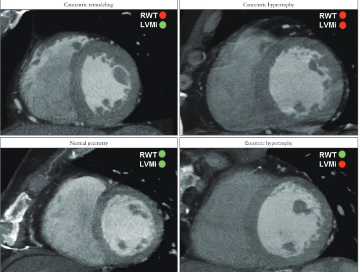 Fig. 3. LV geometry patterns. RWT = 2 × posterior wall thickness / LV internal diameter at end diastole