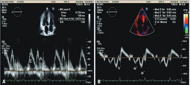 Fig. 1. Mitral flow by conventional pulse Doppler imaging and tissue Doppler imaging. A: Early diastolic (E), late atrial (A) peak  velocities in mitral inflow by conventional pulse Doppler imaging