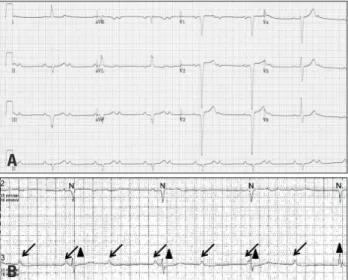 Fig. 1. Electrocardiogram (A) and Holter (B) on admission. 2:1  atrioventricular (AV) block, Q wave in right precordial limb lead (V1, II, III),  absent Q wave in left precordial lead (V5, V6) and left axis deviation (A),  complete AV block (B) (arrow: P w