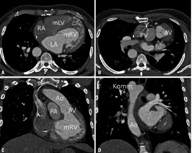 Fig. 5. Cardiac computed tomography, left-sided mRV has moderator band, coarse trabeculations (A)