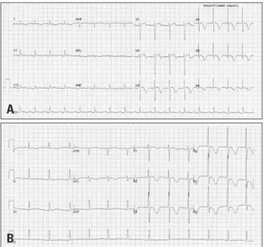 Fig. 1. Electrocardiogram on admission showing ST elevation and T  wave inversion in the precordial leads and a prolonged QT interval (480  msec) (A)