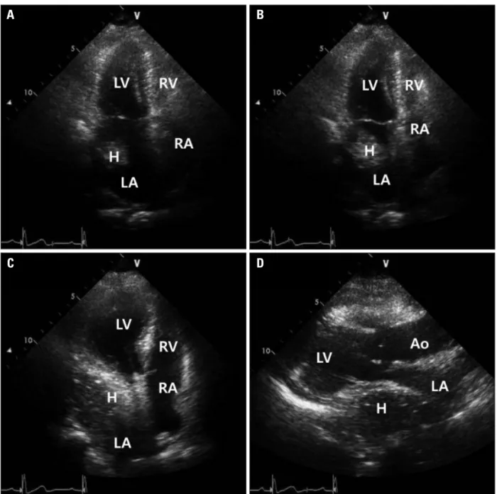 Fig. 1. Hiatal hernia with internal swirling flow. A: Apical 4-chamber view of transthoracic echocardiography shows intracardiac mass in left atrium
