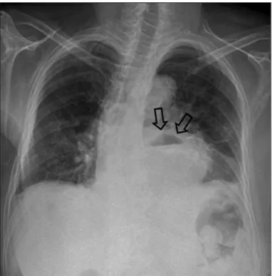 Fig. 2. Chest X-ray showing air-fluid level that suggest large hiatal hernia  (arrows).
