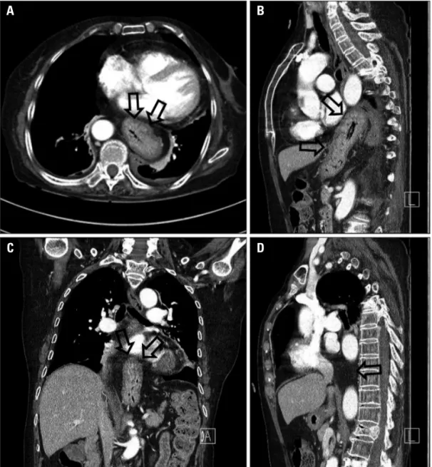 Fig. 4. Chest computed tomography of hiatal hernia showing cardiac mass involving both atria