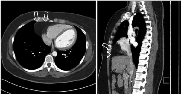 Fig. 6. Chest computed tomography of Morgagni’s hernia. Chest computed tomography shows prominent fat tissue in right cardiophrenic area with  suspicious internal vasculature that suggested Morgagni’s hernia (arrows)