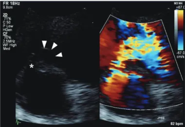 Fig. 1. Initial transthoracic echocardiography. At parasternal short axis  view, perimembranous ventricular septal defect (star) was detected with  2 dimensional and color Doppler echocardiography