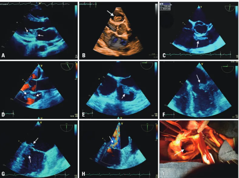Fig. 1. Transthoracic (two-dimensional and three-dimensional) and two-dimensional transesophageal echocardiography display of the endocarditic  lesions, and surgical view of the right-sided vegetation
