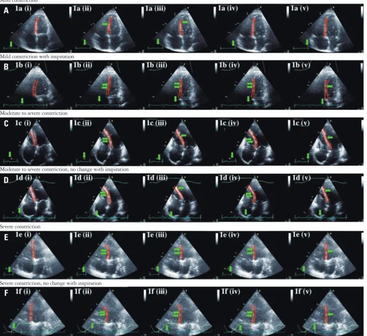 Fig. 1. Mild constriction results in a single wobble of the interventricular septum (A) which is enhanced with inspiration (B)