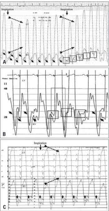 Fig. 2A shows LV and RV pressures for P2 who had moderate  constriction and evidence of a single wobble on  echocardiogra-phy