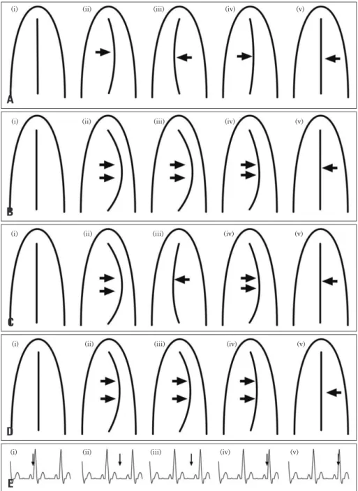 Fig. 3. Schematic diagram showing that the degree of septal deviation caused by constrictive pericarditis, as seen with echocardiography,  varies with clinical severity