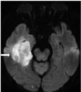 Fig. 1. An embolic infarction in right posterior temporal lobe is seen in  diffusion brain magnetic resonance imaging (arrow).