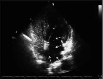 Fig. 3. Chest computed tomography (CT) angiogram. A and B: Thrombi (arrows) exist in both pulmonary arteries according to chest CT