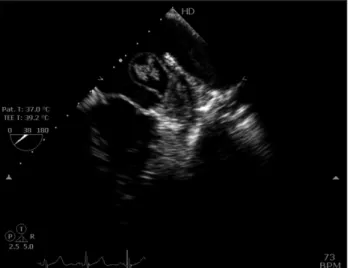 Fig. 1. Cystic mass arising from left atrial appendage with nodular  structures inside it.