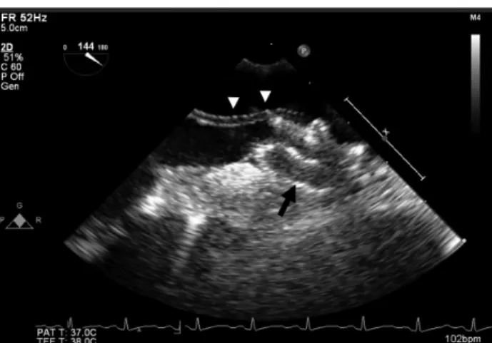 Fig. 1. Transesophageal echocardiographic examination shows about a  13 cm sized linear mass (arrowheads) attached on the tip of the Amplatzer ® PFO occlude device (arrow).