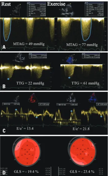 Fig. 3. Example of an asymptomatic patient with severe aortic stenosis  presenting a significant exercise-induced increase in mean trans-aortic  pressure gradient (A) and exercise pulmonary hypertension (B)