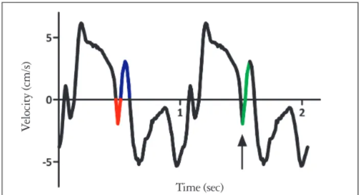 Fig. 1. Schematic presentation of the post-systolic velocity notch  (PSN). On the left the current designation of the post-systolic negative  (red) and positive (blue) velocity waves