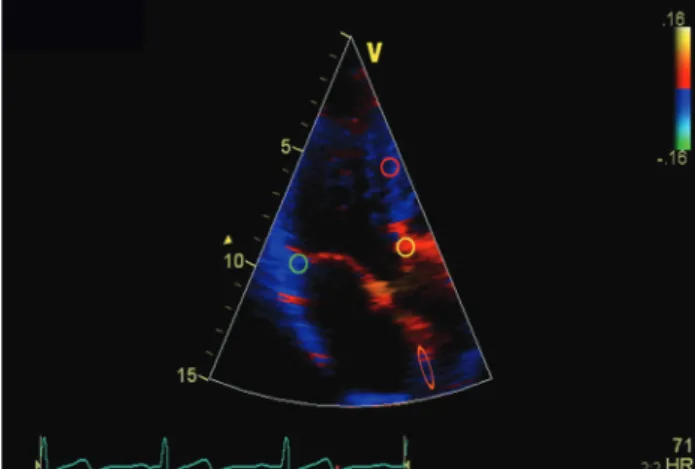 Fig. 2. The measurement levels. yellow: anterior aortic annulus, orange: 