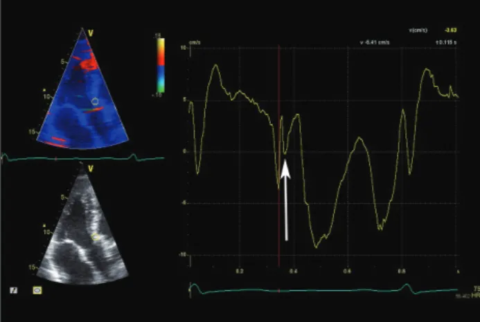 Fig. 5. The second post-systolic velocity notch (PSN) spike at the level  of the anterior aortic annulus