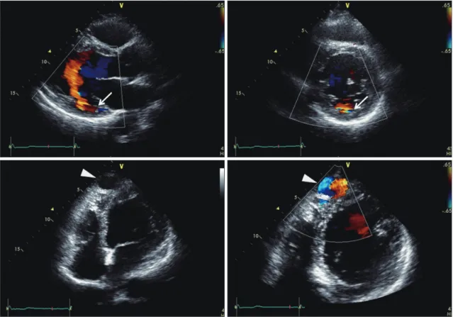 Fig. 2. Coronary computed tomography showed markedly dilated and serpentine whole left coronary arteries