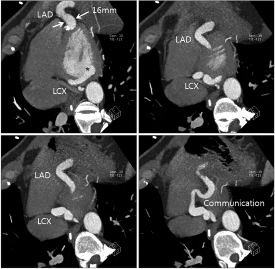 Fig. 3. Coronary computed tomography revealed dilated left coronary arteries and the drainage site to the left  ventricle (asterisk)