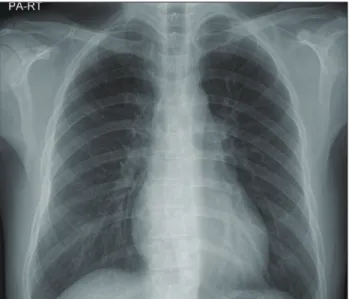 Fig. 5. Follow-up chest X-ray. At a follow-up, a posteroanterior chest  X-ray view shows normalized heart size at 16 months after thyroid  hormone supplementation and heart failure treatment.