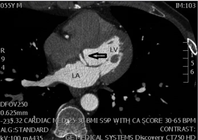 Fig. 5. Coronary computed tomography angiogram. Right coronary  sinus of Valsalva (arrow)
