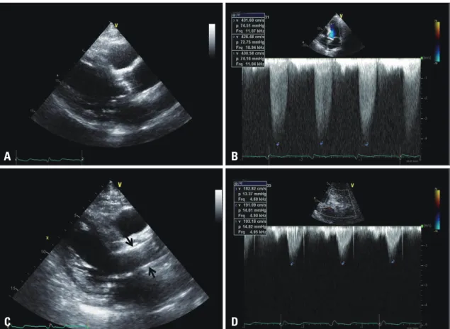 Fig. 1. The baseline parasternal long axis view demonstrates severe calcified aortic valve (A) with increased transaortic valve  maximal velocity up to 4.3 m/sec (B)