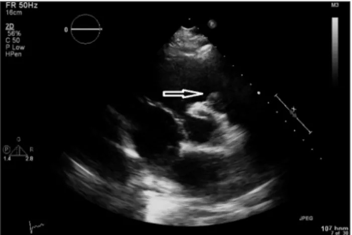 Fig. 1. Transthoracic echocardiogram. Left parasternal short axis view  at the level of the aortic valve showing (arrow) large sized vegetation  attached to the pulmonic valve.