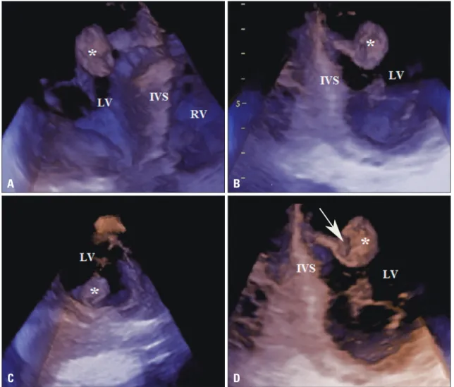 Fig. 2. Three dimensional (3D) transthoracic echocardiography. The mass within the LV cavity (indicated by *) can be viewed from  different imaging planes (A-D) with the help of cropping the basic 3D data set
