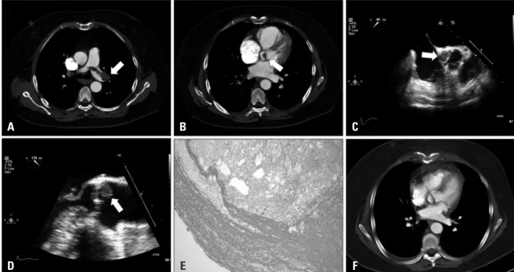 Fig. 1. A: Chest computed tomography with contrast showing pulmonary embolism at the bifurcation of the common pulmonary artery and in its  main branches (arrow)
