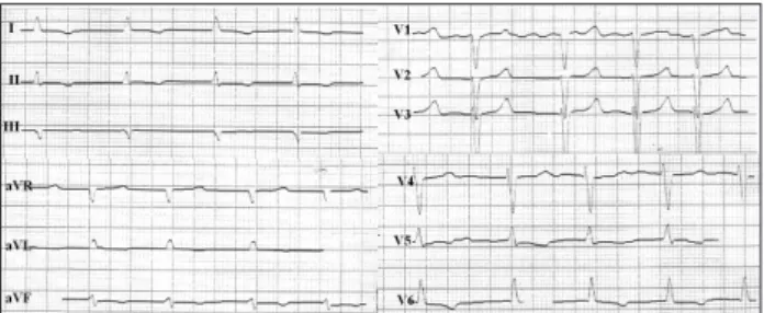 Fig. 1. An electrocardiogram revealed atrial fibrillation rhythm, normal  axis and non-specific ST-T changes in inferior and lateral leads.