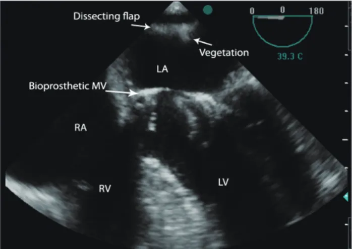 Fig. 2. Transesophageal echocardiography in mid esophageal four  chamber view (0 degree) demonstrated a linear dissecting flap and its  attached (irregular shaped) particles originated from left atrial wall