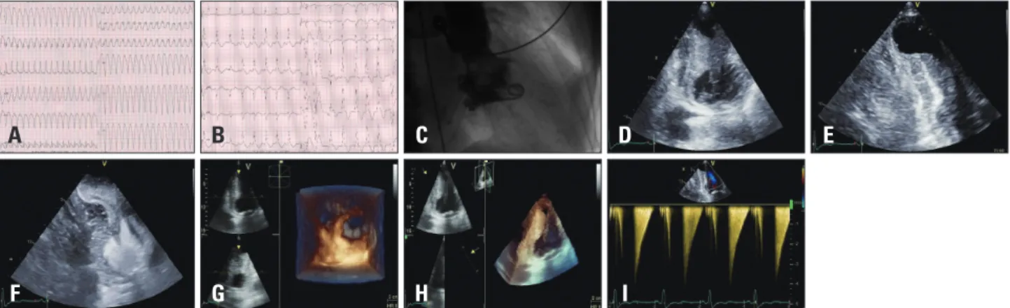 Fig. 1. A: Presenting electrocardiogram showing ventricular tachycardia at 200 beats/min