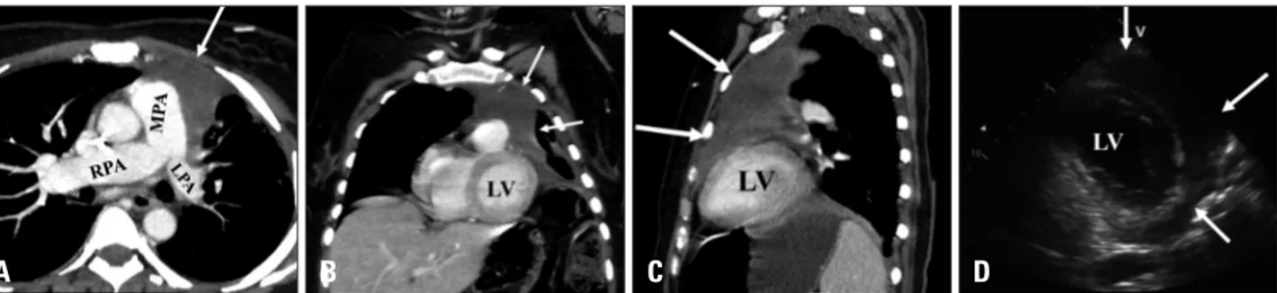 Fig. 1. Contrast-enhanced computed tomography showing a large heterogeneous anterior mediastinal mass (arrows) invading the mediastinal  structures and left anterior chest wall with encirclement and compression of the main and left pulmonary arteries (A)