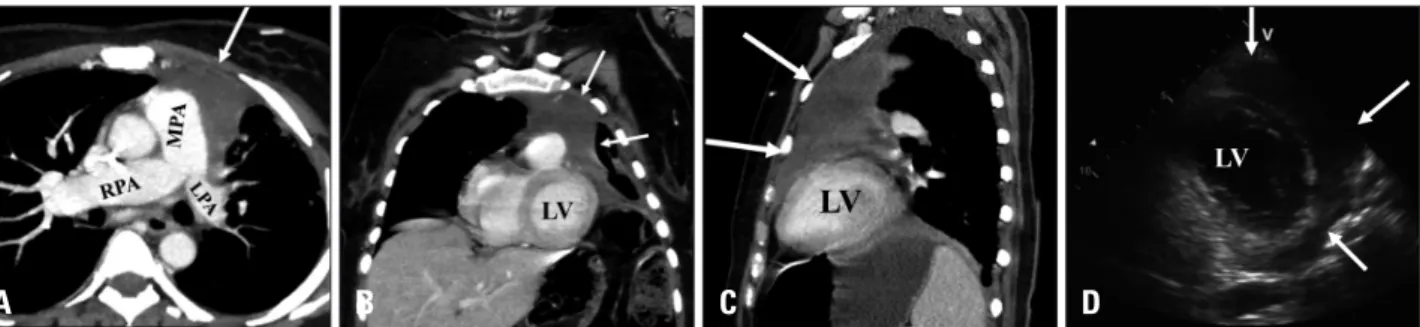 Fig. 1. Contrast-enhanced computed tomography showing a large heterogeneous anterior mediastinal mass (arrows) invading the mediastinal  structures and left anterior chest wall with encirclement and compression of the main and left pulmonary arteries (A)