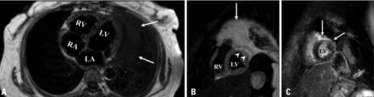 Fig. 2. A: Axial T1-weighted imaging showing the mass inseparable from the left ventricular wall (arrows)