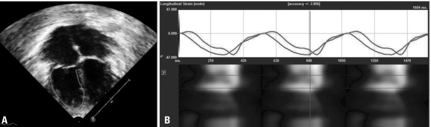 Fig. 1. A: The endocardial border was manually traced, starting from the tricuspid annulus to the right ventricular apex, in a moving image of a  modified apical four-chamber view
