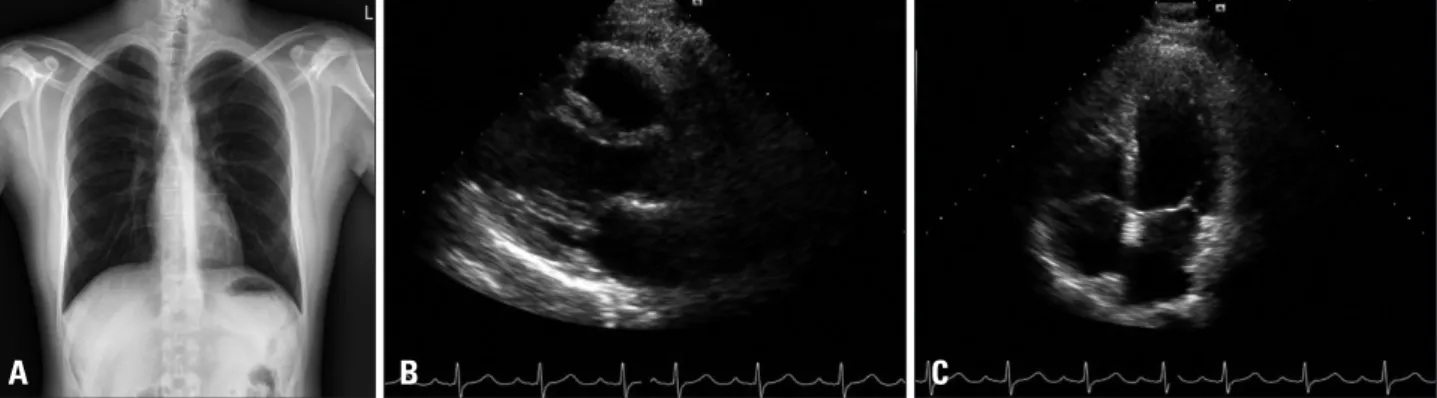 Fig. 2. Initial chest X-ray (A) and transthoracic echocardiography of parasternal long axis (B) and apical 4-chamber view (C)