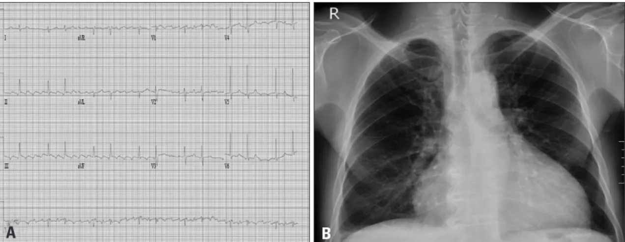 Fig. 1. Electrocardiography demonstrated atrial flutter with a ventricular rate of 77 bpm (A)