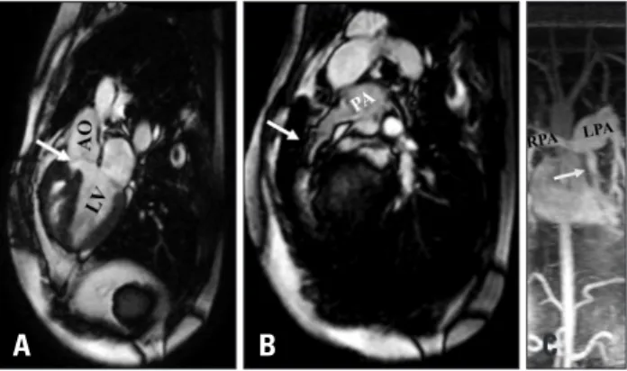 Fig. 2. A: Cardiac magnetic resonance (CMR) sagittal image showing  overriding of the ascending aorta with malalignment ventricular septal  defect (arrow)