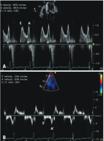Fig. 1. The initial electrocardiogram showed left ventricular hypertrophy  with a strain pattern, ST-T changes in leads II, III, aVF, V3-V6.