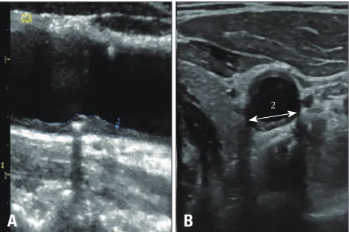 Fig. 3. Calculation of a modified plaque volume as the 2 dimensional  ultrasound plaque area in the longitudinal plane (A) multiplied by plaque  width (B) measured in the cross sectional plane (1 × 2).