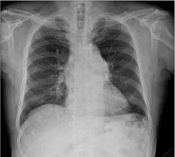 Fig. 1. Chest X-ray shows dilated main pulmonary artery. 
