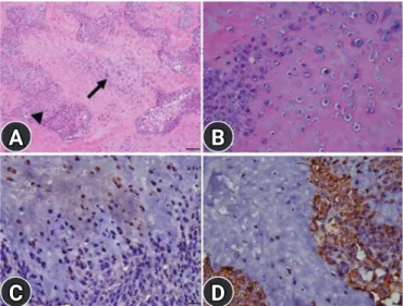 Fig. 2. Histopathological findings. (A) Biphasic patterns of carti- carti-lage (arrow) and undifferentiated mesenchymal tissues  (arrow-head) (H&amp;E, scale bar: 100 μm)