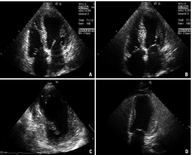Fig. 1. Electrocardiography showing persistent ST segment elevation during the first admission (A) and 3 months follow-up (B).