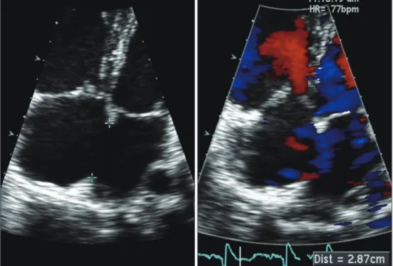 Fig. 2. Initial echocardiography reveals D-shaped left ventricle compressed by dilated right ventricle