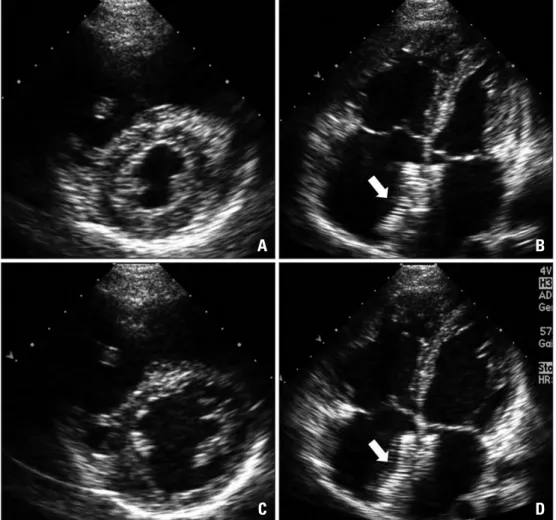 Fig. 4. The follow-up transthoracic echocardiogram shows the markedly reduced size of the right ventricle and  increased left ventricular dimensions with slight compression after percutaneous closure