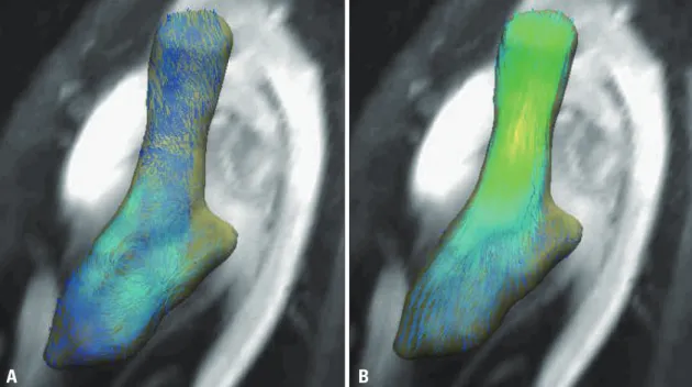 Fig. 1. Four-dimensional flow magnetic resonance imaging (MRI) and visualization of 3-dimensional flow