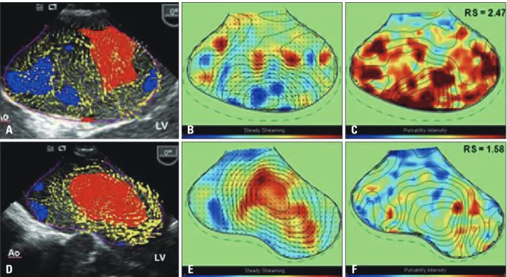 Fig. 6. The echo freeze frames (A and D) parametric representation of steady streaming field (B and E) and the pulsatile strength field (C and F) in the  control group (upper panel) and the atrial fibrillation (AF) group (lower panel)